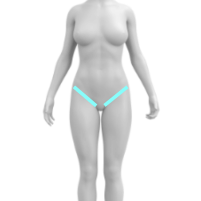 Laser Hair Removal for Women's Bikini Line